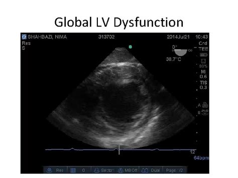 global lv dysfunction.